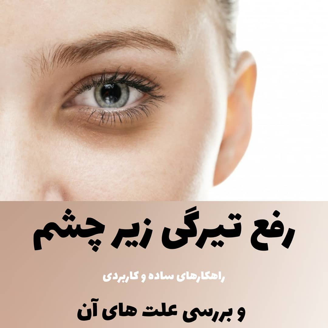 رفع تیرگی زیر چشم